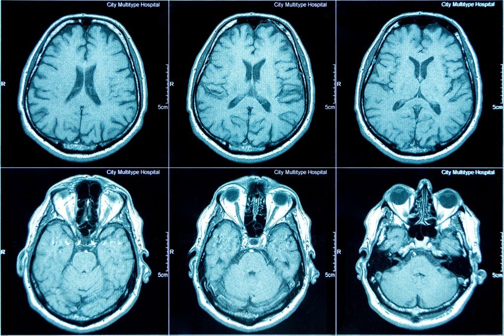 The Origin of a Broken&nbsp;Mind